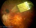 retina_implant_in_RP.jpg